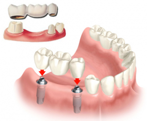 Restaurations dentaires fixes couronnes et ponts